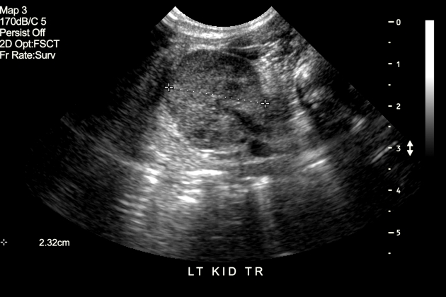 sindrom hemolitic uremic